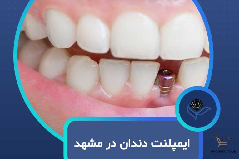 ایمپلنت دندان در مشهد  با اقساط بلندمدت و شرایط ویژه