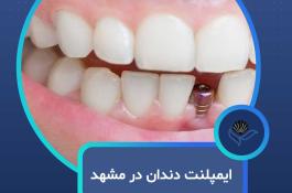 ایمپلنت دندان در مشهد  با اقساط بلندمدت و شرایط ویژه