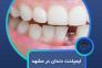 ایمپلنت دندان در مشهد با اقساط بلند مدت، بدون پیش پرداخت ( دیگه نگران هزینهها نباش )